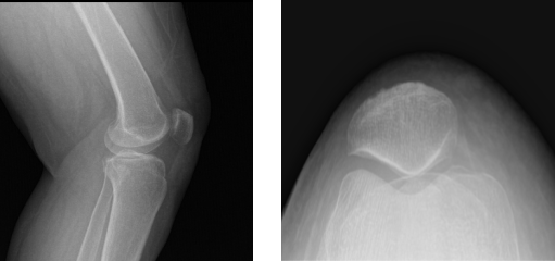 Radiografía de rodilla izquierda completa con rótula