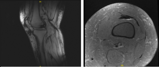 MRI-3T Rodilla izquierda sin contraste