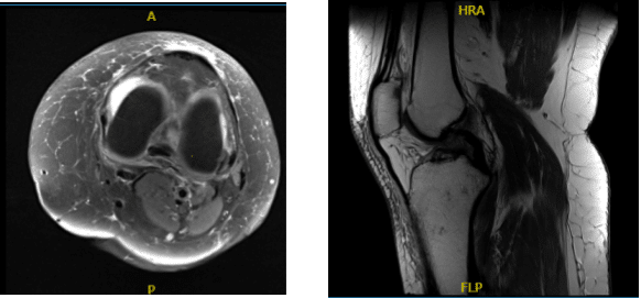 MRI-3T Rodilla izquierda sin contraste