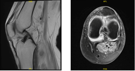 MRI-3T Rodilla izquierda sin contraste