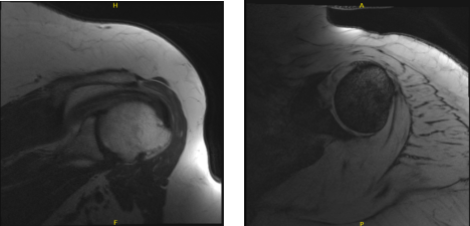 MRI-3T Hombro izquierdo sin contraste