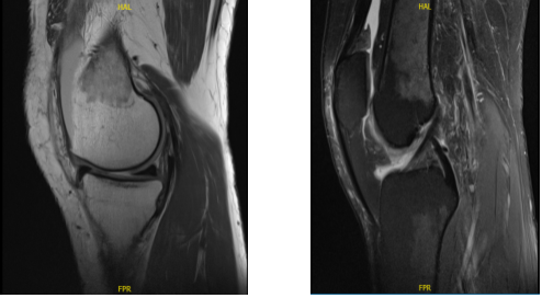 MRI-3T Rodilla izquierda sin contraste