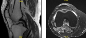 Resonancia magnética - 3T rodilla derecha sin contraste