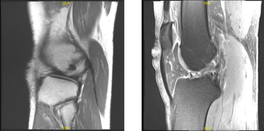 Resonancia magnética de rodilla derecha sin contraste