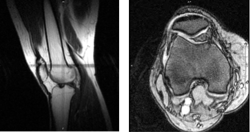 Resonancia magnética de la rodilla derecha