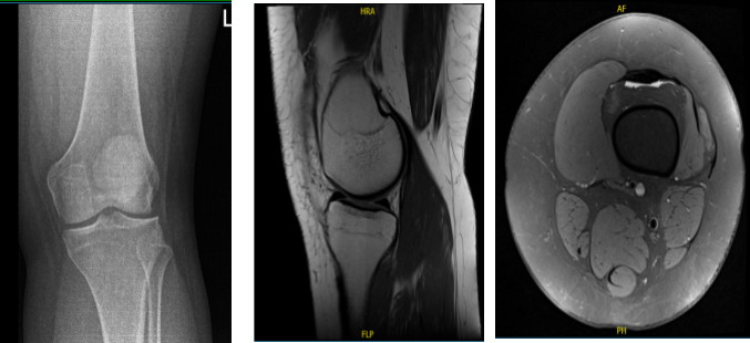 Resonancia magnética de la rodilla izquierda