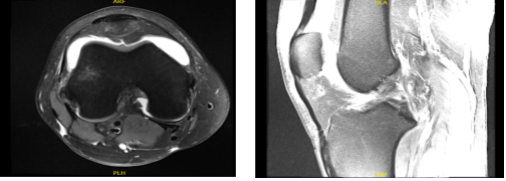 MRI-3T Rodilla derecha sin contraste