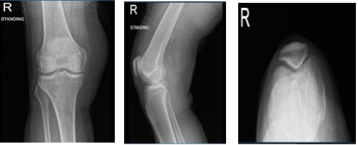 Radiografía de rodilla derecha completa con rótula