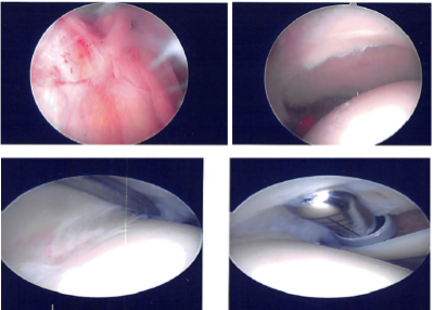 Intraoperative Arthroscopy Images