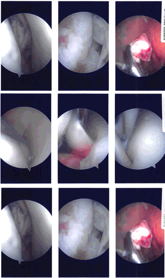 Imágenes de artroscopia intraoperatoria